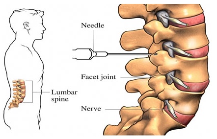 Neck pain after epidural steroid injection