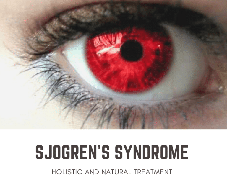 Natural Treatments For Sjogren’s Syndrome Part 3
