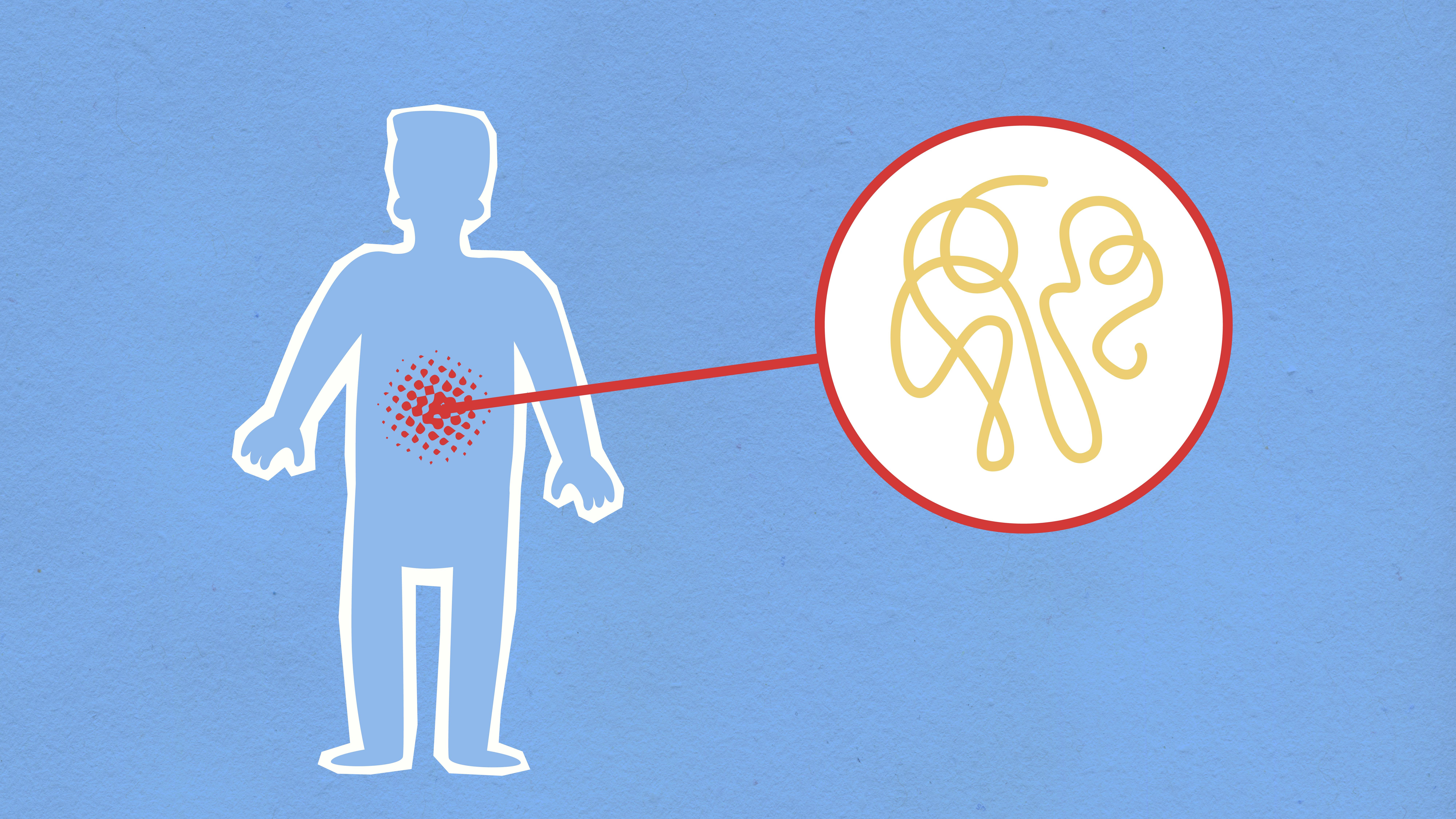 SIFO: The Complete Guide to Symptoms, Causes, and Why Chinese Coptis Outperforms Standard Antifungals